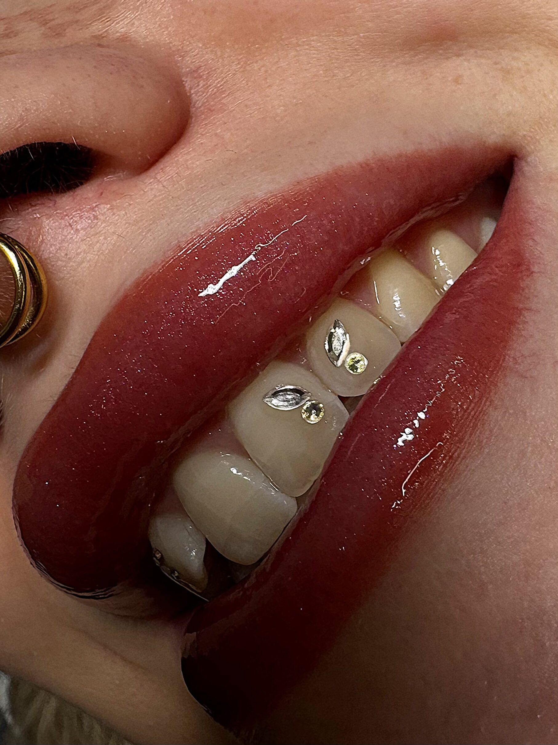 Sorriso con gemme dentali applicate in studio