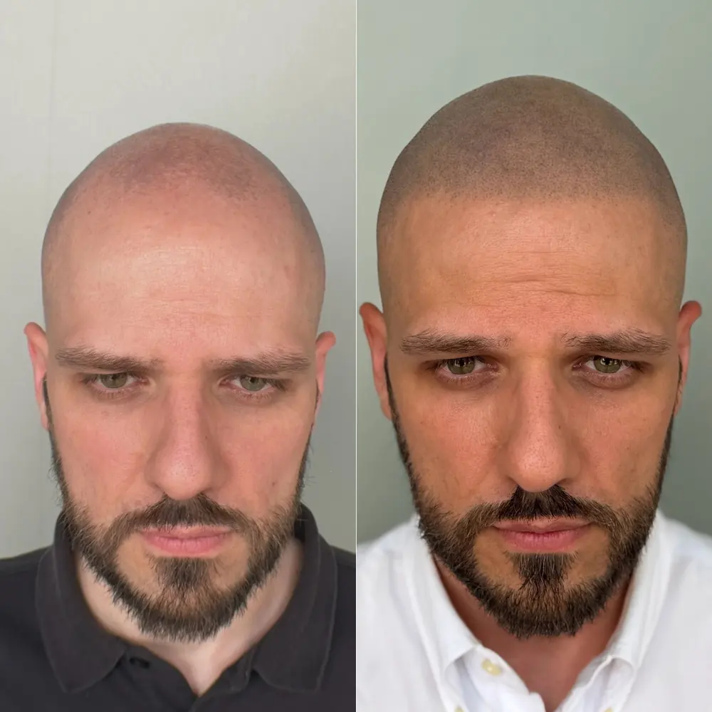 Tricopigmentazione prima e dopo: nuova linea frontale su cliente con diradamento