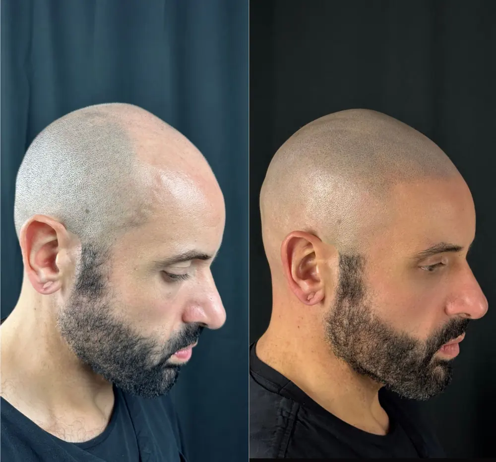 Tricopigmentazione effetto rasato, prima e dopo: vista di tre quarti
