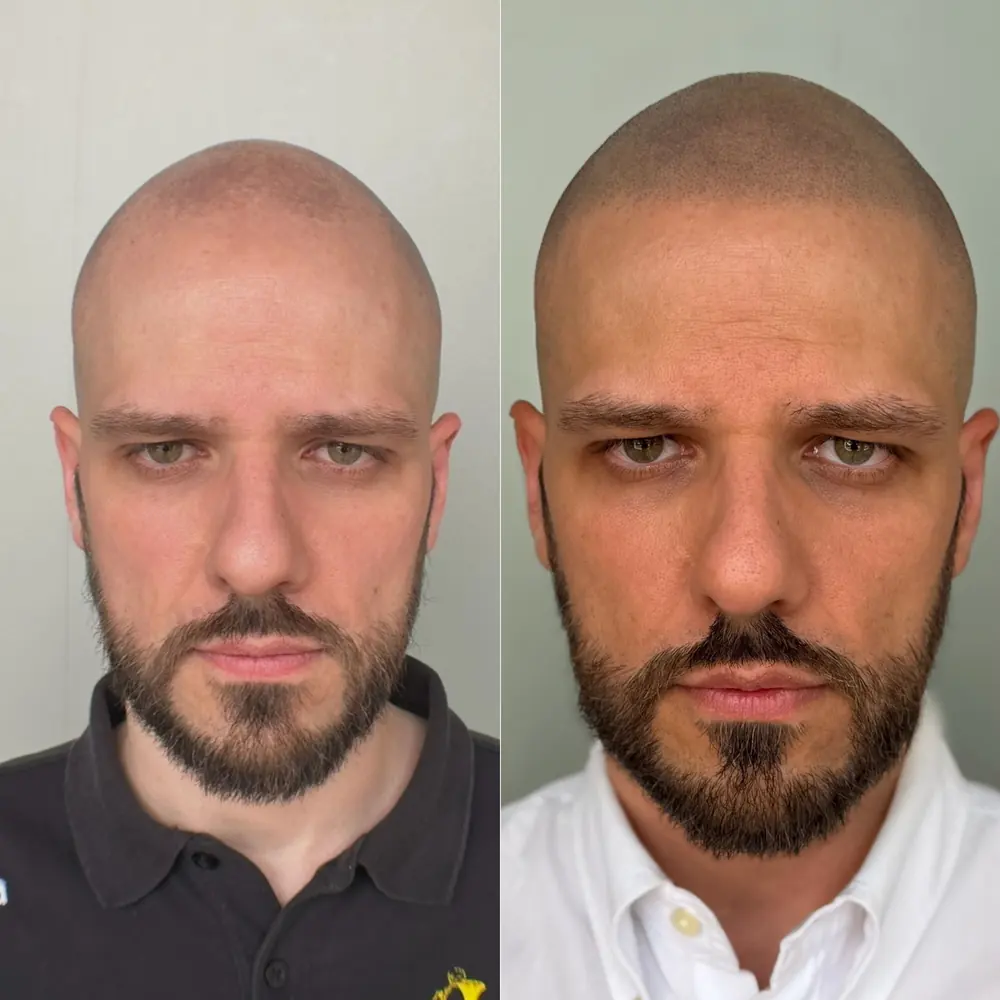 Tricopigmentazione prima e dopo: effetto rasato naturale, vista frontale